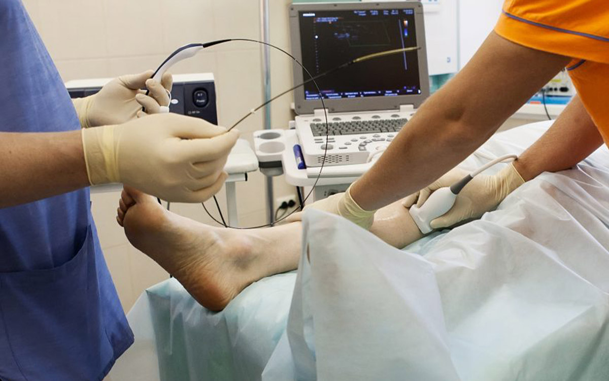 Damar İçi Radyofrekansla Varis Tedavisi