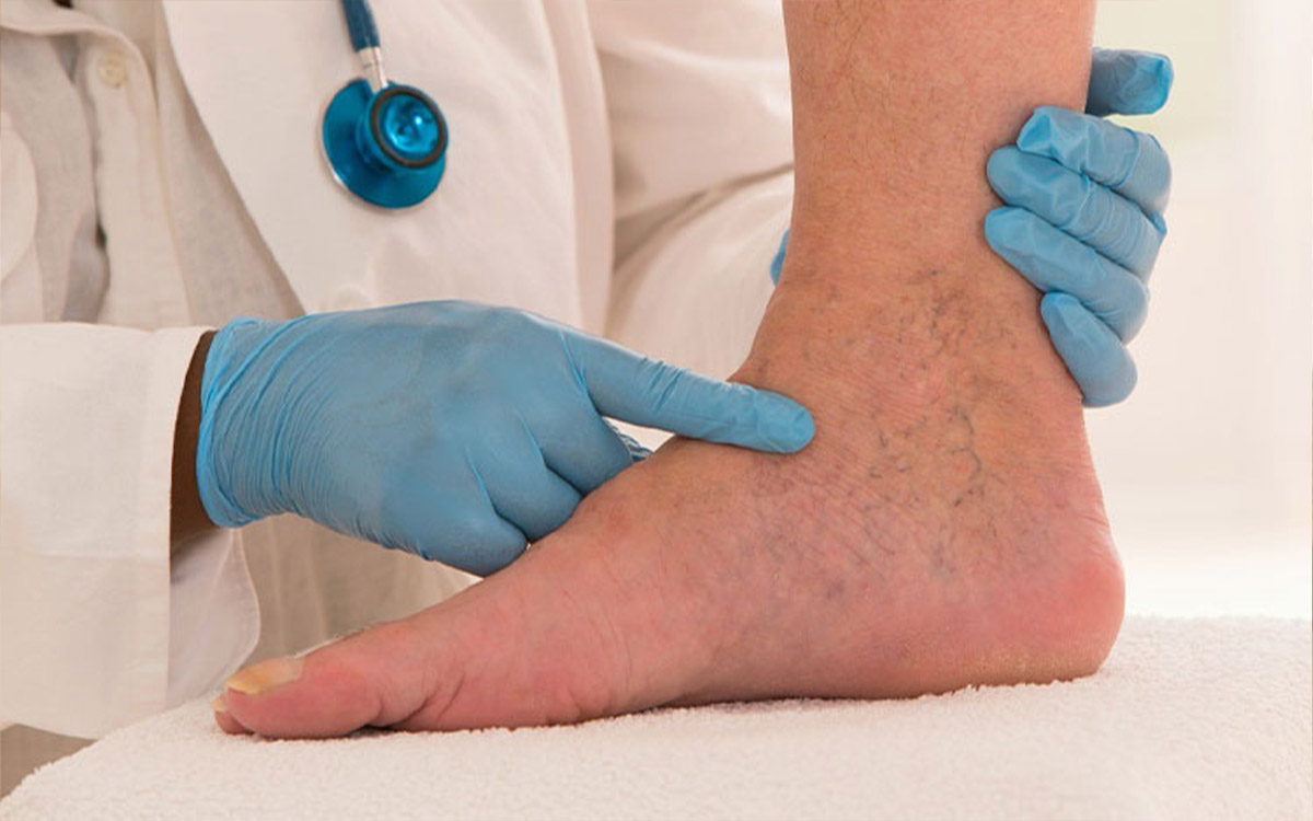 Derin Ven Trombozu Nedir?