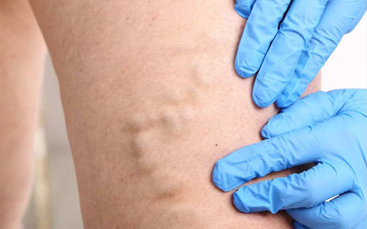 Köpükle Varis Tedavisi