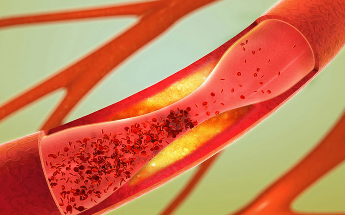 Periferik Arter Hastalığı Belirtileri