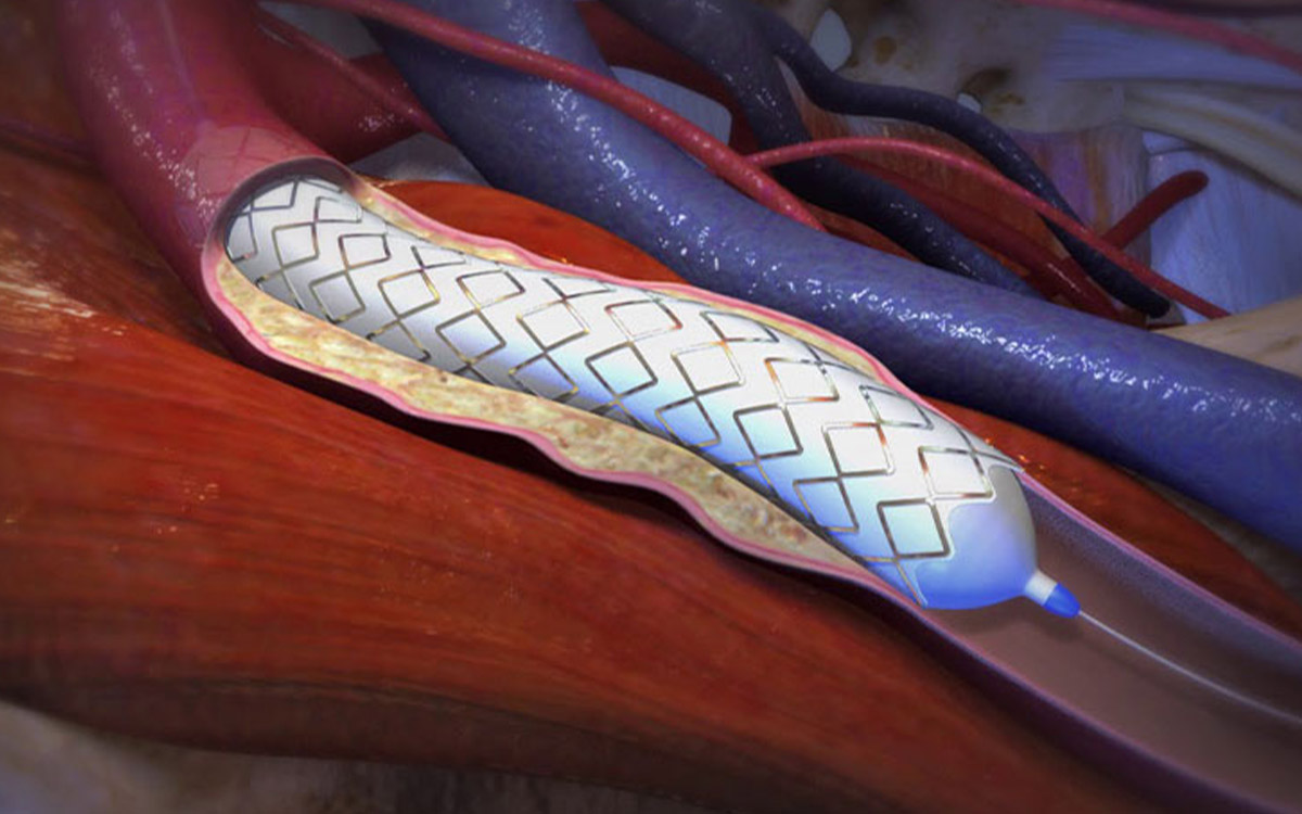 Periferik Arter Hastalıklarında Endovasküler Tedavi