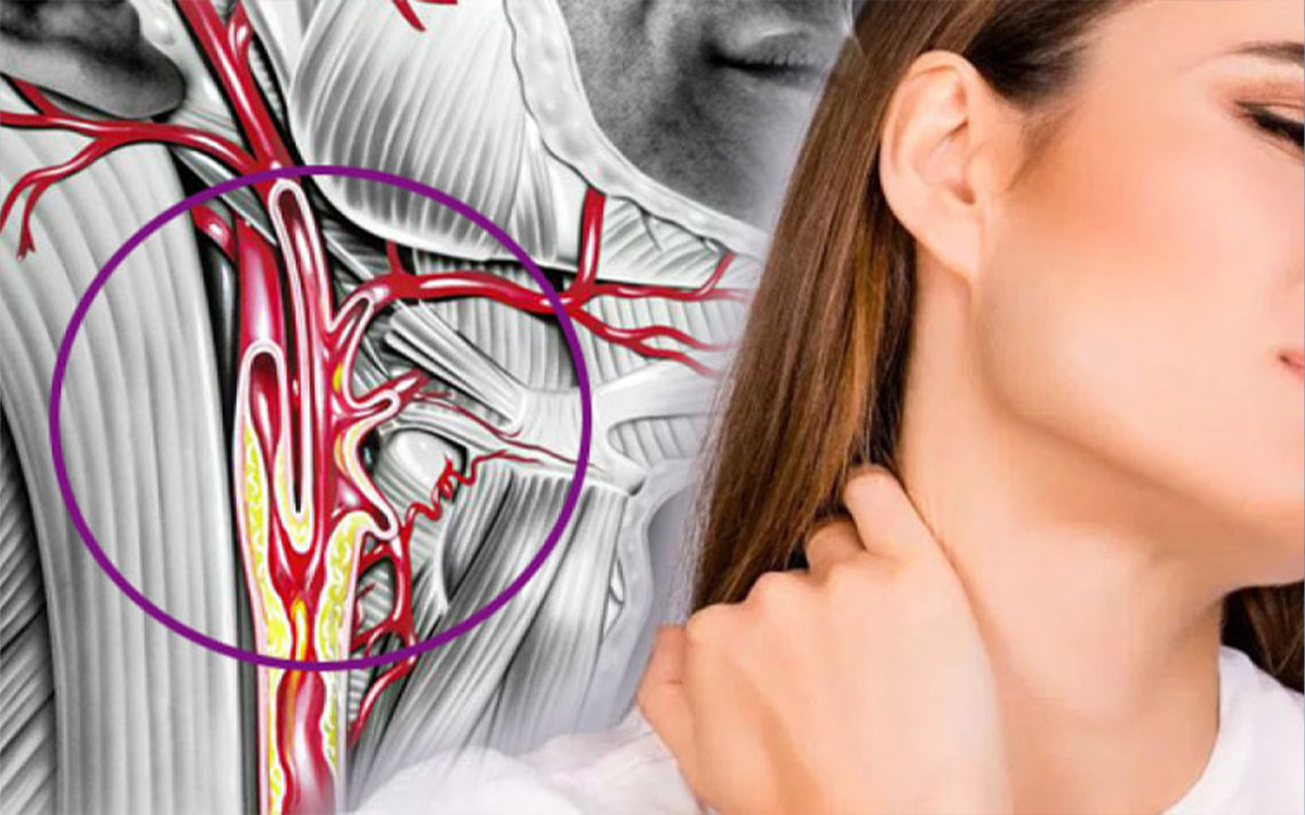 Şah Damarı Tıkanıklığı Risk Faktörleri