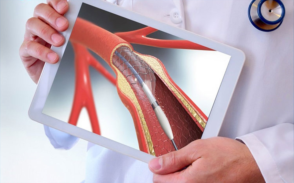 Şah Damarı Tıkanıklığı Tedavisi