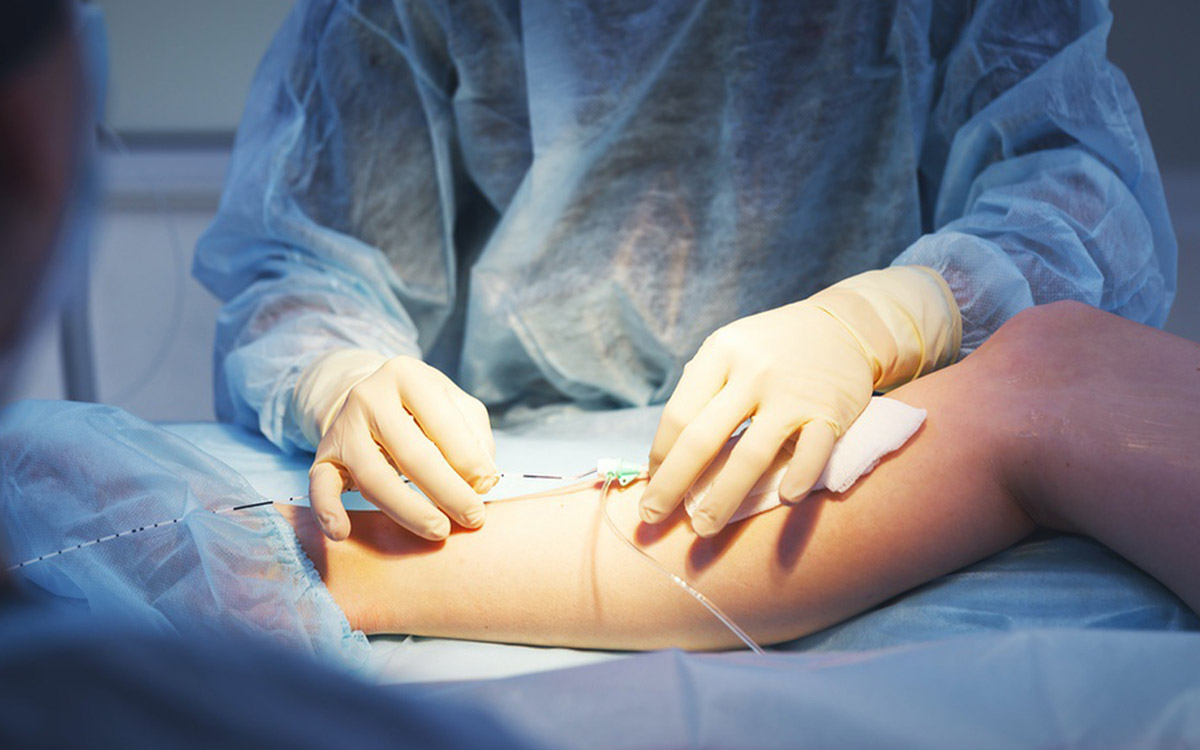 Varicose Vein Surgery