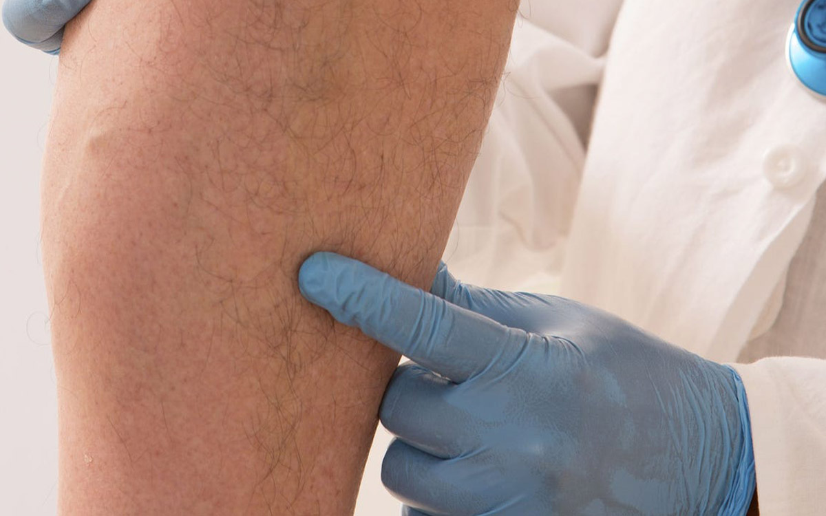 What are the Symptoms of Varicose Veins?