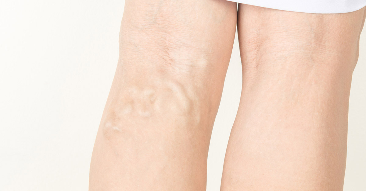 A Known but Inexplicable Threat: Varicose Vein!