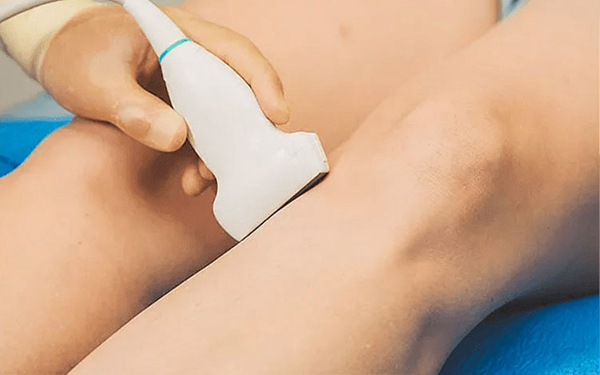 Transdermal Radyofrekansla Varis Tedavisi