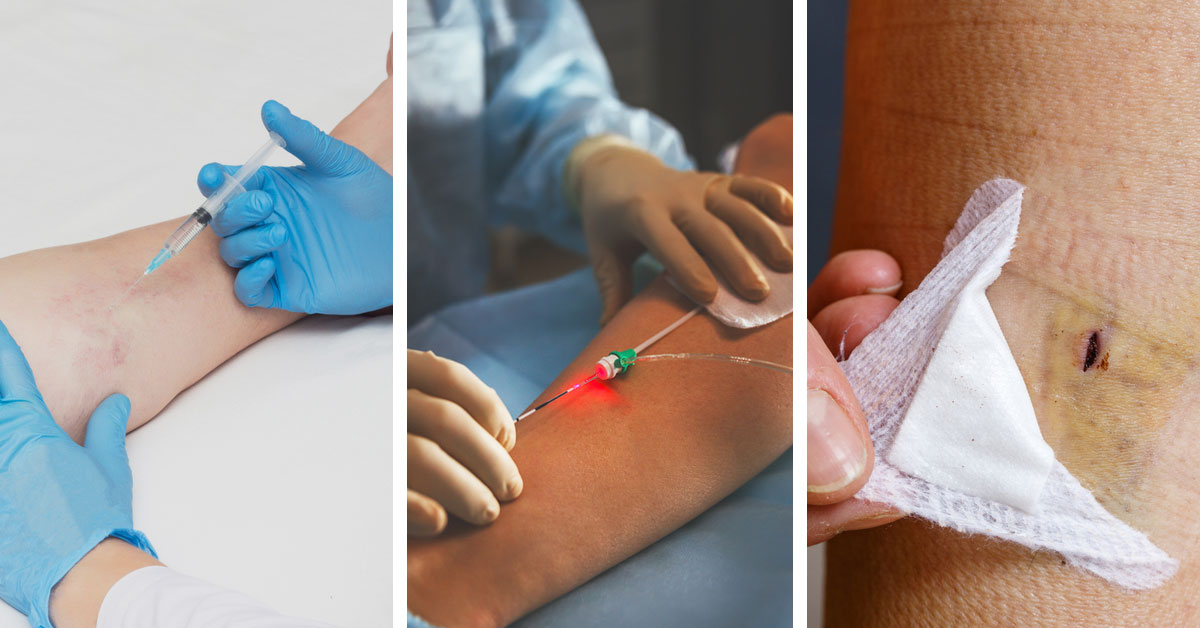 Varis Tedavisi Öncesi ve Sonrasında Nelere Dikkat Etmelisiniz?