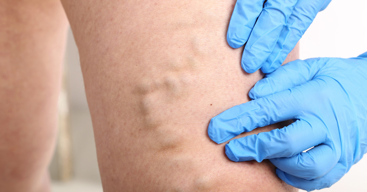 Varis Tedavisinde Mikrocerrahi Yöntemi